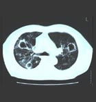 肺結核