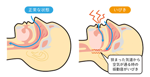 いびきとは何か