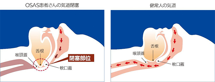 いびきとは何か