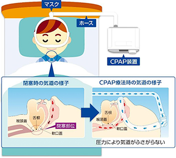 睡眠無呼吸時症候群（SAS）の治療